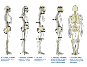 SPINAL CURVATURE – Back To Life Chiropractic