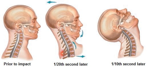 WHIPLASH EFFECTS & SYMPTOMS – Back To Life Chiropractic