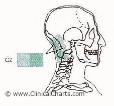 C2 Subluxation earache – Back To Life Chiropractic